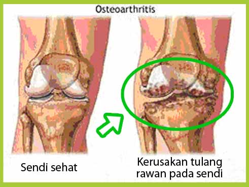 Osteoarthristis
